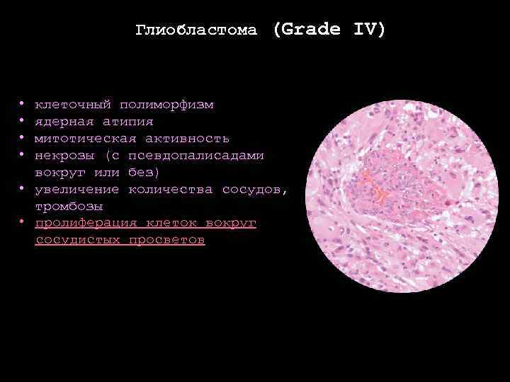 Глиобластома (Grade IV) • • клеточный полиморфизм ядерная атипия митотическая активность некрозы (с псевдопалисадами