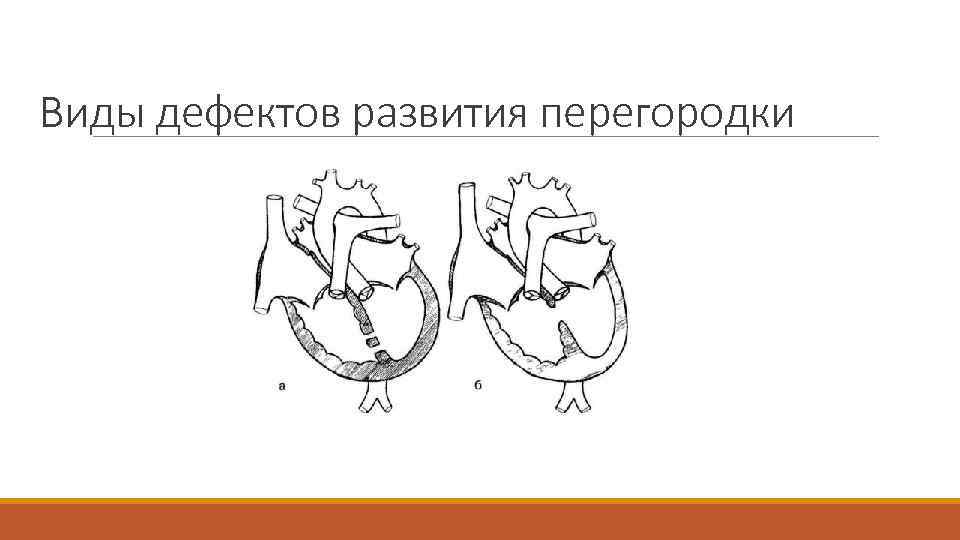 Виды дефектов развития перегородки 