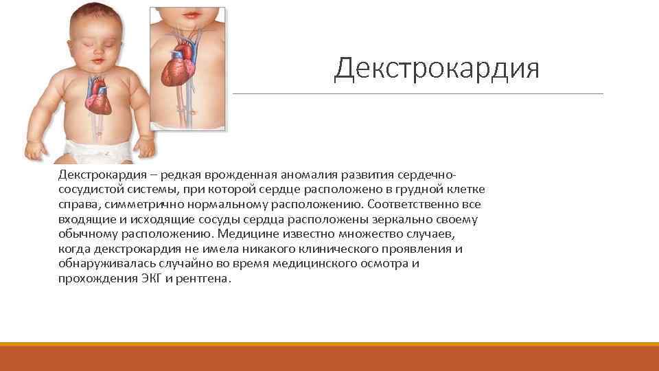 Декстрокардия – редкая врожденная аномалия развития сердечнососудистой системы, при которой сердце расположено в грудной