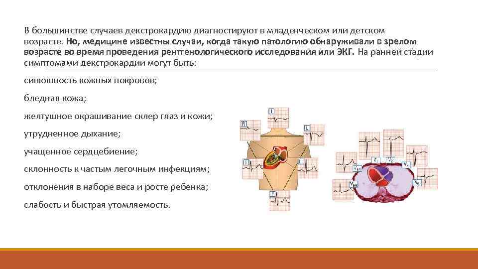  В большинстве случаев декстрокардию диагностируют в младенческом или детском возрасте. Но, медицине известны