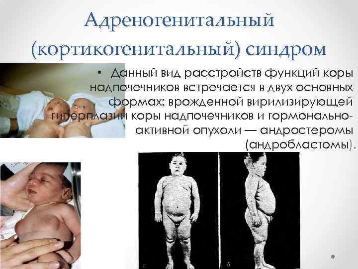 Адреногенитальный (кортикогенитальный) синдром • Данный вид расстройств функций коры надпочечников встречается в двух основных