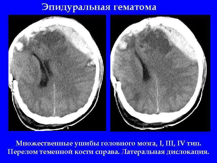 Эпидуральная гематома Множественные ушибы головного мозга, I, III, IV тип. Перелом теменной кости справа.