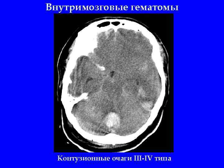 Внутримозговые гематомы Контузионные очаги III-IV типа 