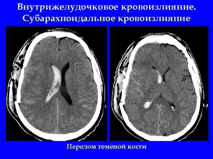 Субарахноидальное кровоизлияние головного мозга фото