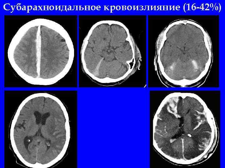 Картинки субарахноидальное кровоизлияние