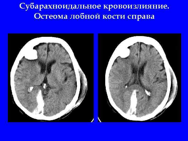 Остеома лобной кости фото