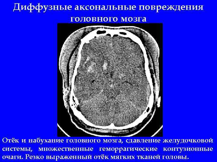Диффузные аксональные повреждения головного мозга Отёк и набухание головного мозга, сдавление желудочковой системы, множественные