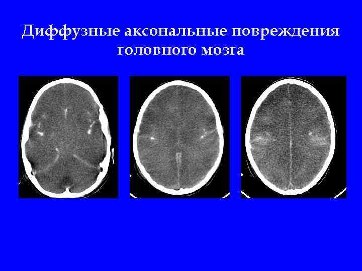 Диффузные аксональные повреждения головного мозга 