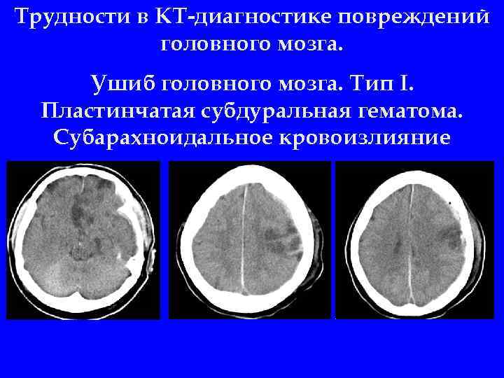 Трудности в КТ-диагностике повреждений головного мозга. Ушиб головного мозга. Тип I. Пластинчатая субдуральная гематома.