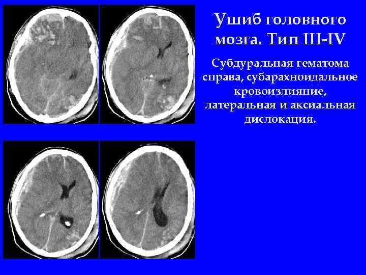 Ушиб головного мозга картинки