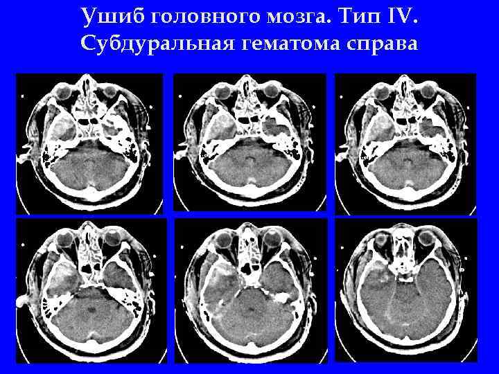 Ушиб головного мозга карта вызова скорой помощи