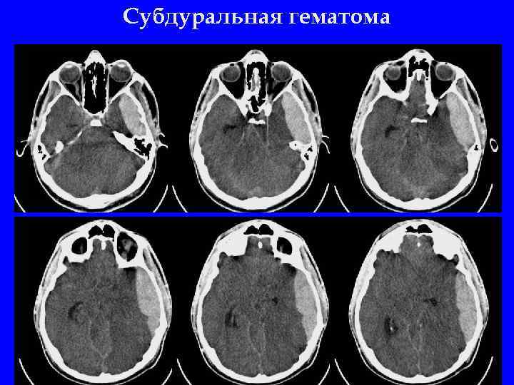 Субдуральная гематома 