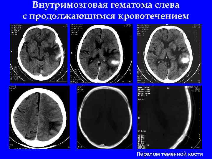 Внутримозговая гематома слева с продолжающимся кровотечением Перелом теменной кости 
