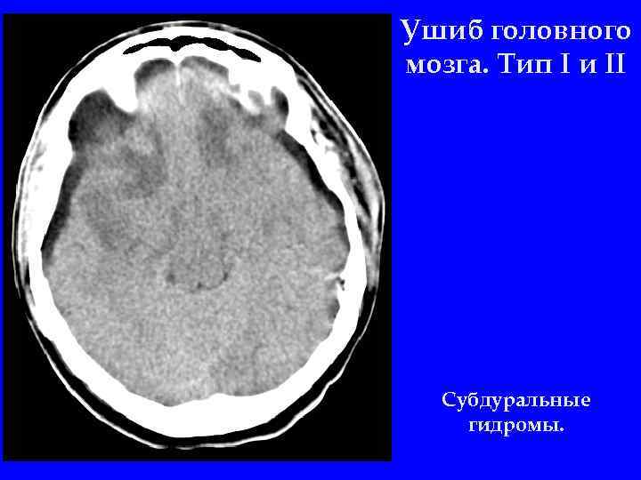 Ушиб головного мозга картинки