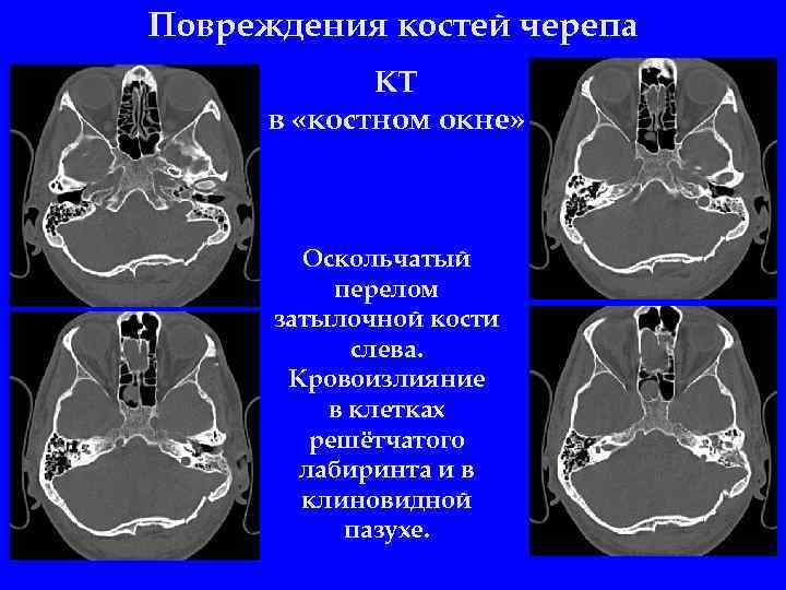 Картинки перелом черепа