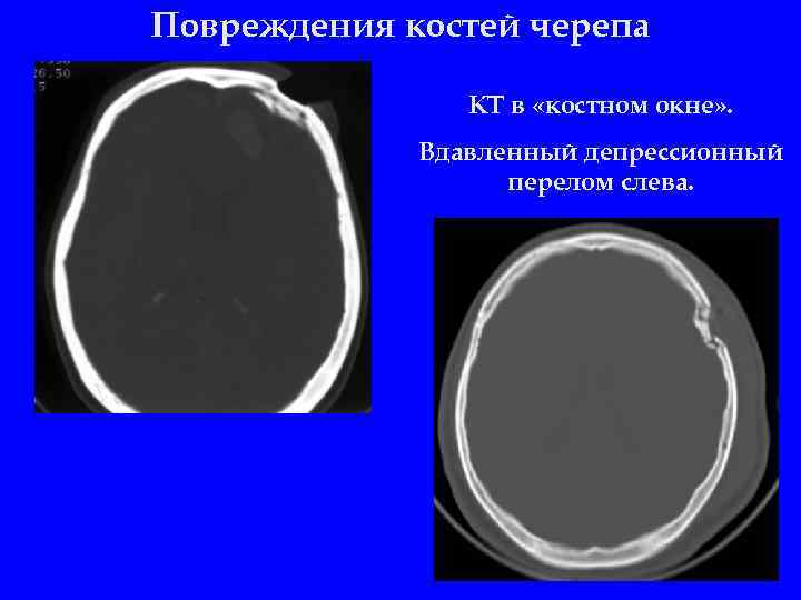 Повреждения костей черепа КТ в «костном окне» . Вдавленный депрессионный перелом слева. 