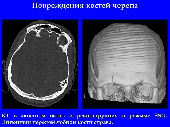 Повреждения костей черепа КТ в «костном окне» и реконструкция в режиме SSD. Линейный перелом