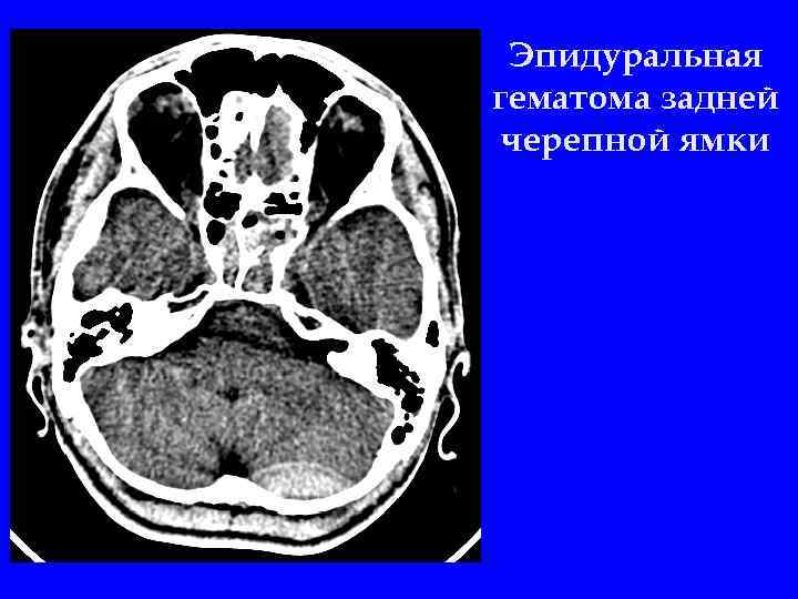 Эпидуральная гематома задней черепной ямки 