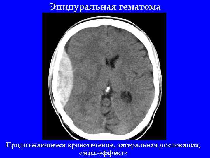 Эпидуральная гематома Продолжающееся кровотечение, латеральная дислокация, «масс-эффект» 