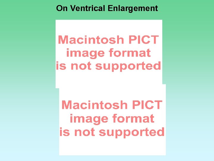 On Ventrical Enlargement 