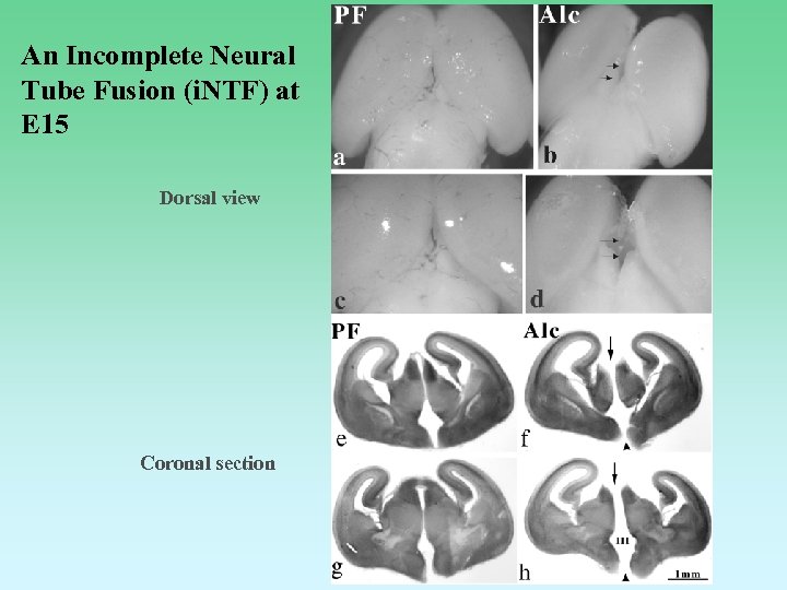 An Incomplete Neural Tube Fusion (i. NTF) at E 15 Dorsal view Coronal section