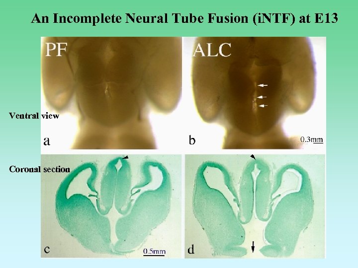 An Incomplete Neural Tube Fusion (i. NTF) at E 13 Ventral view Coronal section