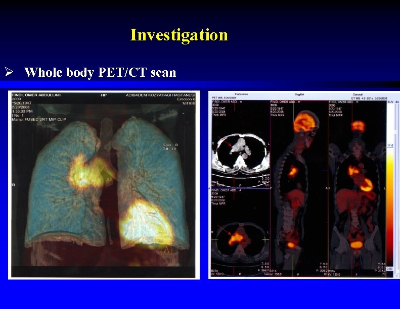 Investigation Ø Whole body PET/CT scan 