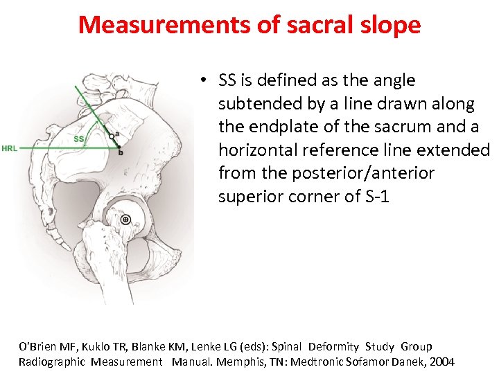 Measurements of sacral slope • SS is defined as the angle subtended by a