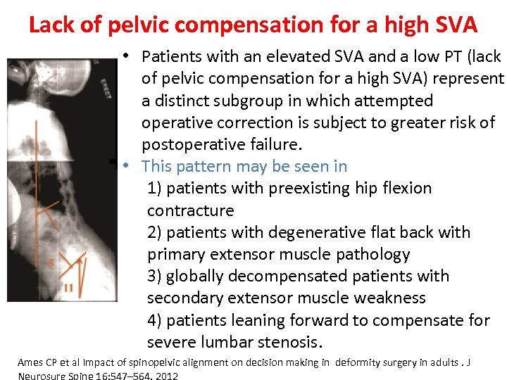 Lack of pelvic compensation for a high SVA • Patients with an elevated SVA