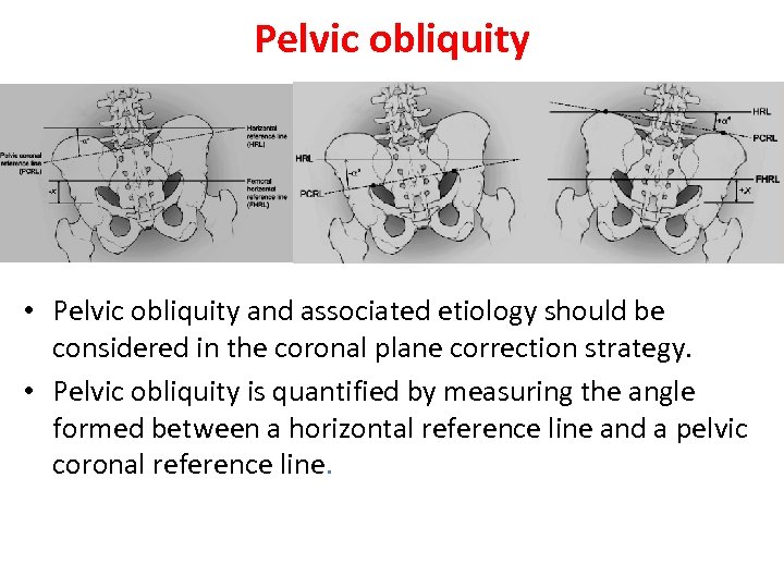 Pelvic obliquity • Pelvic obliquity and associated etiology should be considered in the coronal