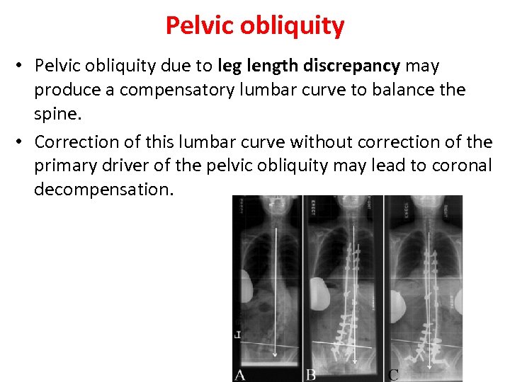 Pelvic obliquity • Pelvic obliquity due to leg length discrepancy may produce a compensatory