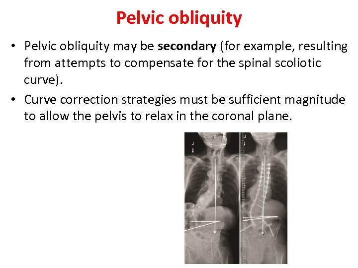 Pelvic obliquity • Pelvic obliquity may be secondary (for example, resulting from attempts to