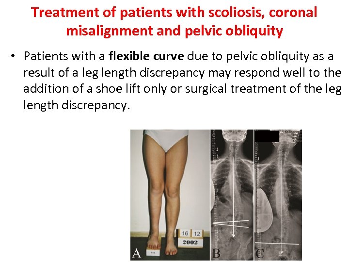 Treatment of patients with scoliosis, coronal misalignment and pelvic obliquity • Patients with a