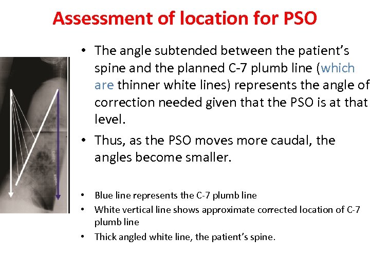 Assessment of location for PSO • The angle subtended between the patient’s spine and