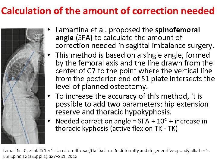 Calculation of the amount of correction needed • Lamartina et al. proposed the spinofemoral