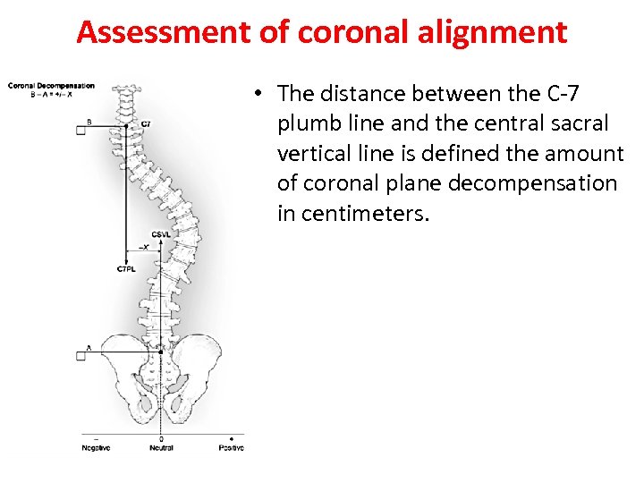 Assessment of coronal alignment • The distance between the C-7 plumb line and the