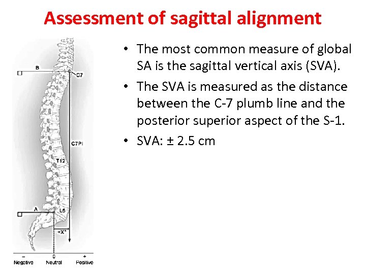 Assessment of sagittal alignment • The most common measure of global SA is the