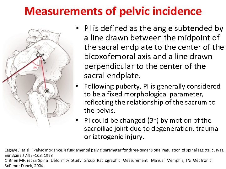 Measurements of pelvic incidence • PI is defined as the angle subtended by a