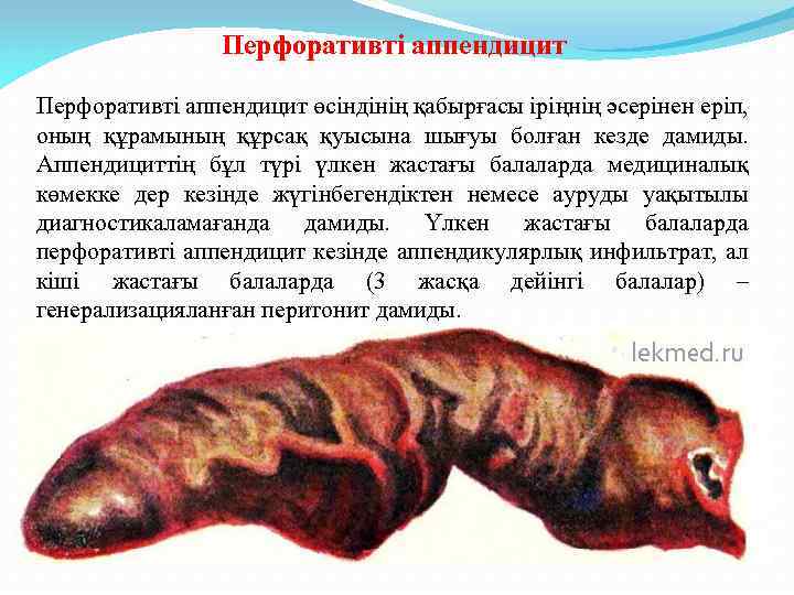 Перфоративті аппендицит өсіндінің қабырғасы іріңнің әсерінен еріп, оның құрамының құрсақ қуысына шығуы болған кезде