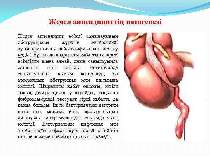 Жедел аппендициттің патогенезі Жедел аппендицит өсінді саңылауының обструкциясы жүретін энтерогенді аутоинфекциялы бейспецификалық қабыну үрдісі.