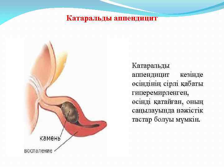 Катаральды аппендицит кезінде өсіндінің сірлі қабаты гиперемирленген, өсінді қатайған, оның саңылауында нәжістік тастар болуы