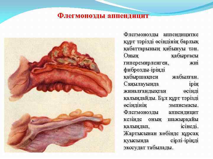 Флегмонозды аппендицитке құрт тәрізді өсіндінің барлық қабаттарының қабынуы тән. Оның қабырғасы гиперемирленген, жиі фиброзды-іріңді