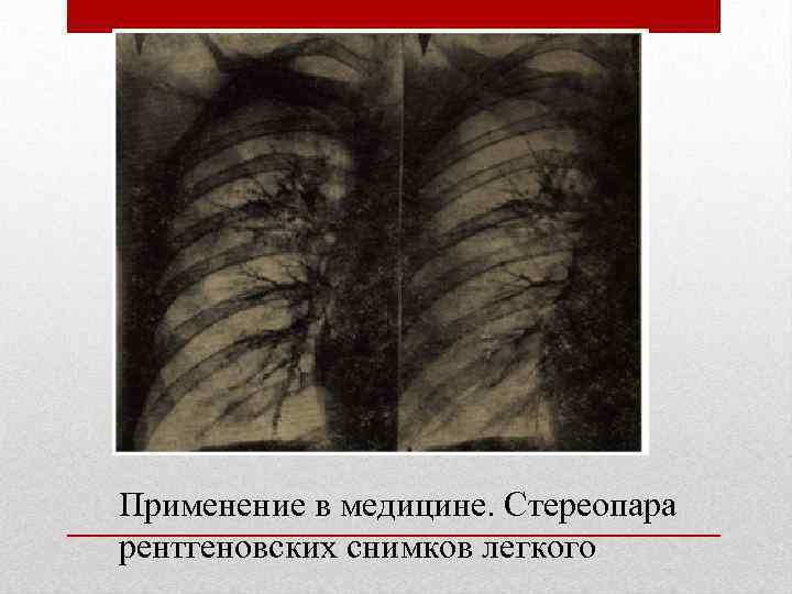 Применение в медицине. Стереопара рентгеновских снимков легкого 