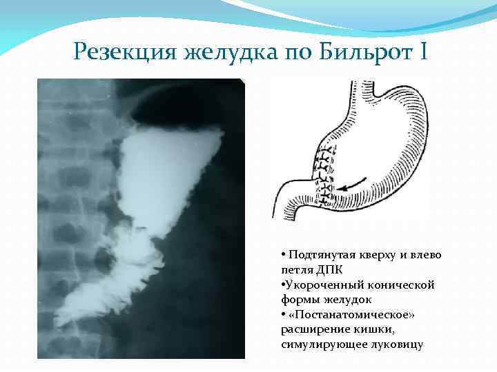 Резекция желудка по Бильрот I • Подтянутая кверху и влево петля ДПК • Укороченный