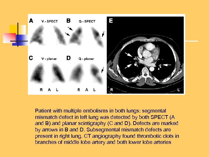 Patient with multiple embolisms in both lungs: segmental mismatch defect in left lung was