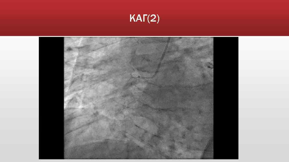 КАГ(2) 