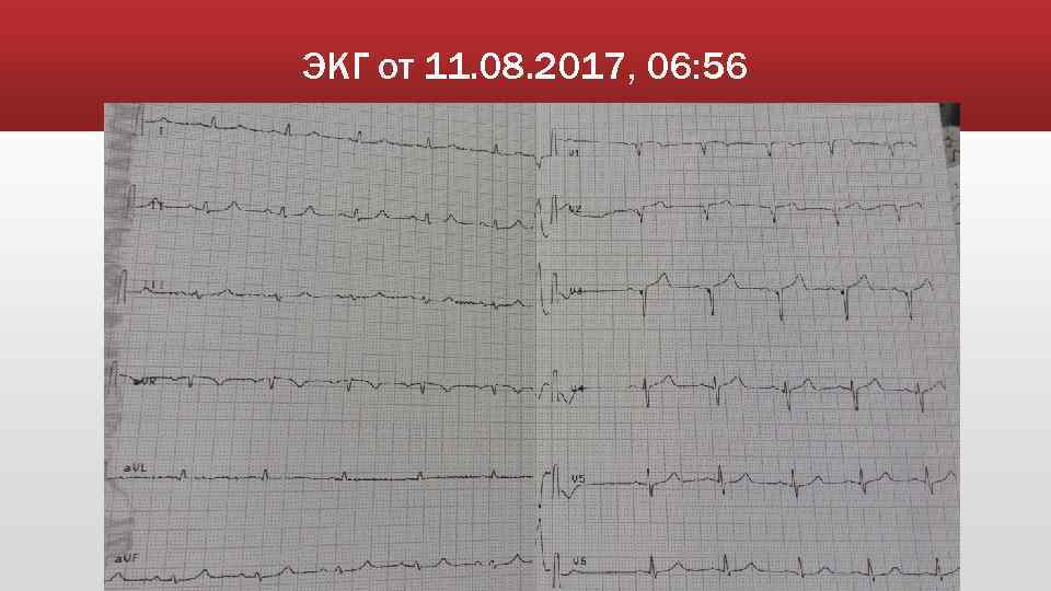ЭКГ от 11. 08. 2017, 06: 56 