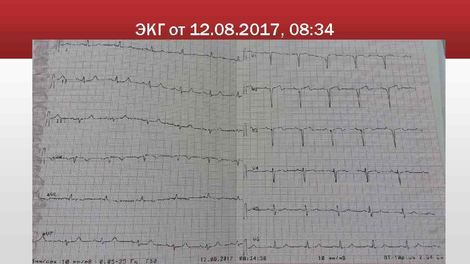 ЭКГ от 12. 08. 2017, 08: 34 