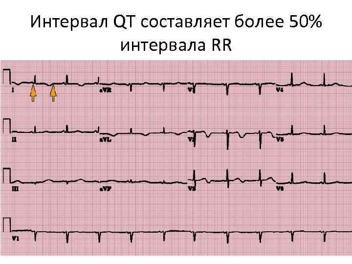 Интервал QT составляет более 50% интервала RR 