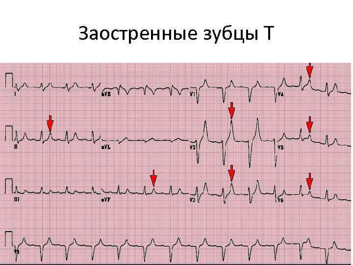 Заостренные зубцы Т 